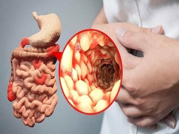 Nguyên nhân của việc hấp thu không đủ bao gồm bệnh Crohn